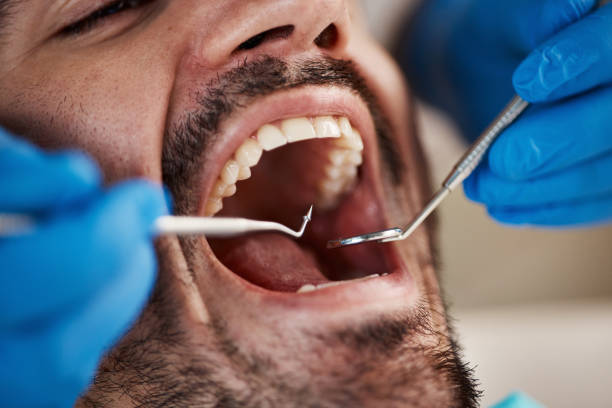 Best Emergency Tooth Extraction in Lakeview, OH